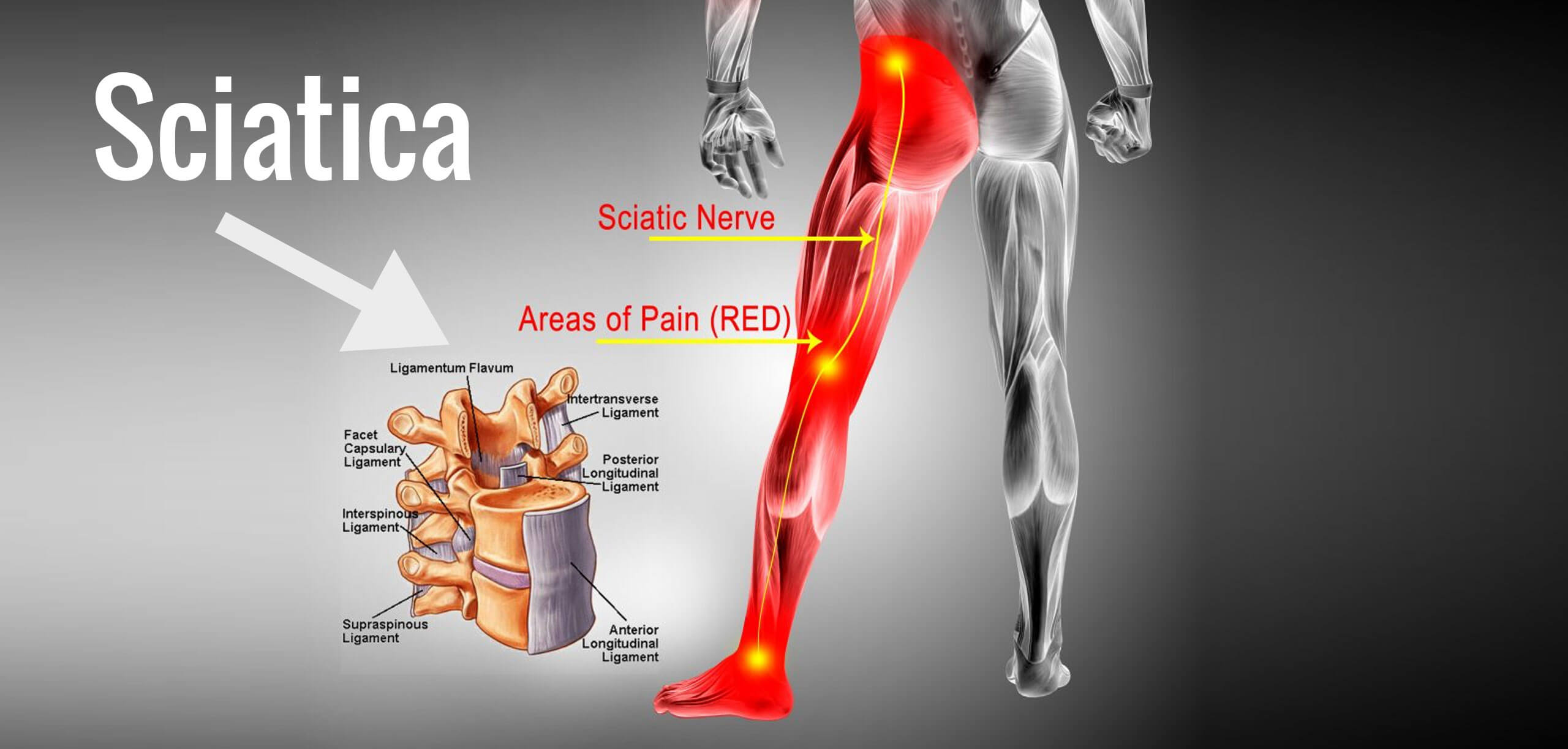 How Massage Therapy Provides Relief From Sciatica Pain - Advanced  Chiropractic Spine & Sports Medicine