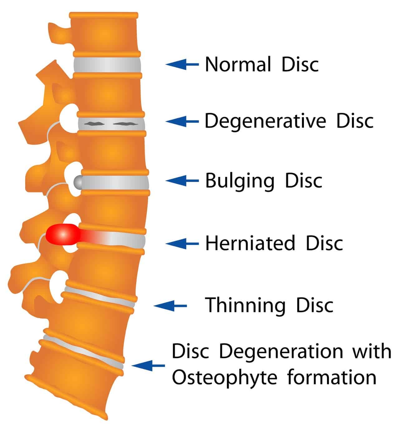 What is the main cause of a herniated disc?