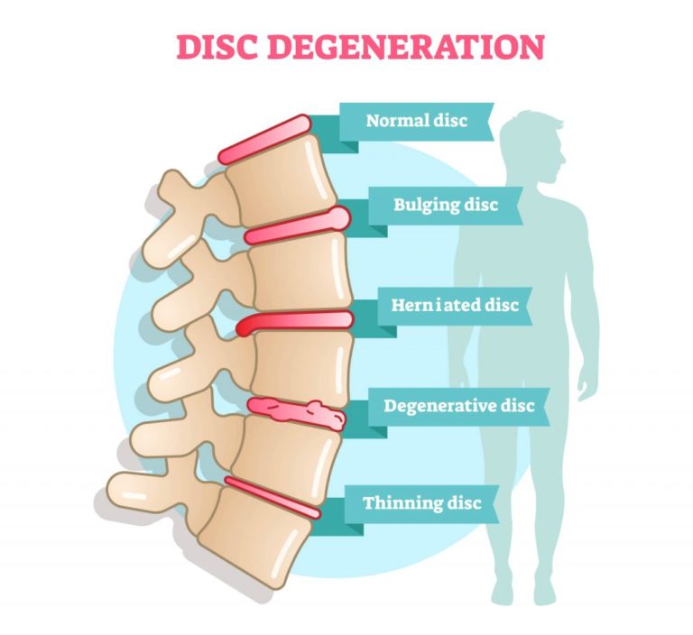 Is a bulging disc more serious than a herniated disc?