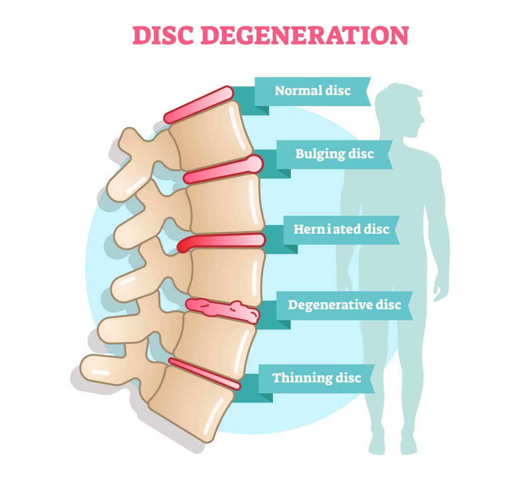 What's Worse—Bulging or Herniated Discs?