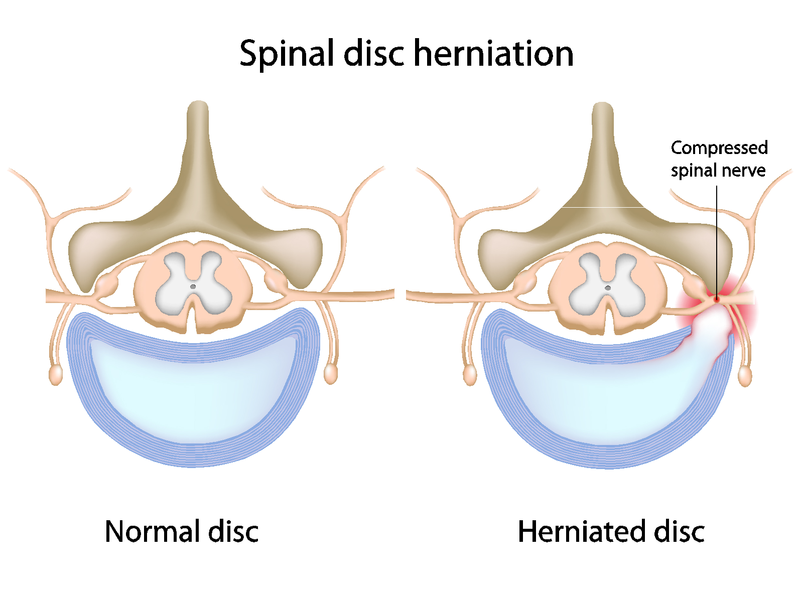 Herniated Disc Exercises