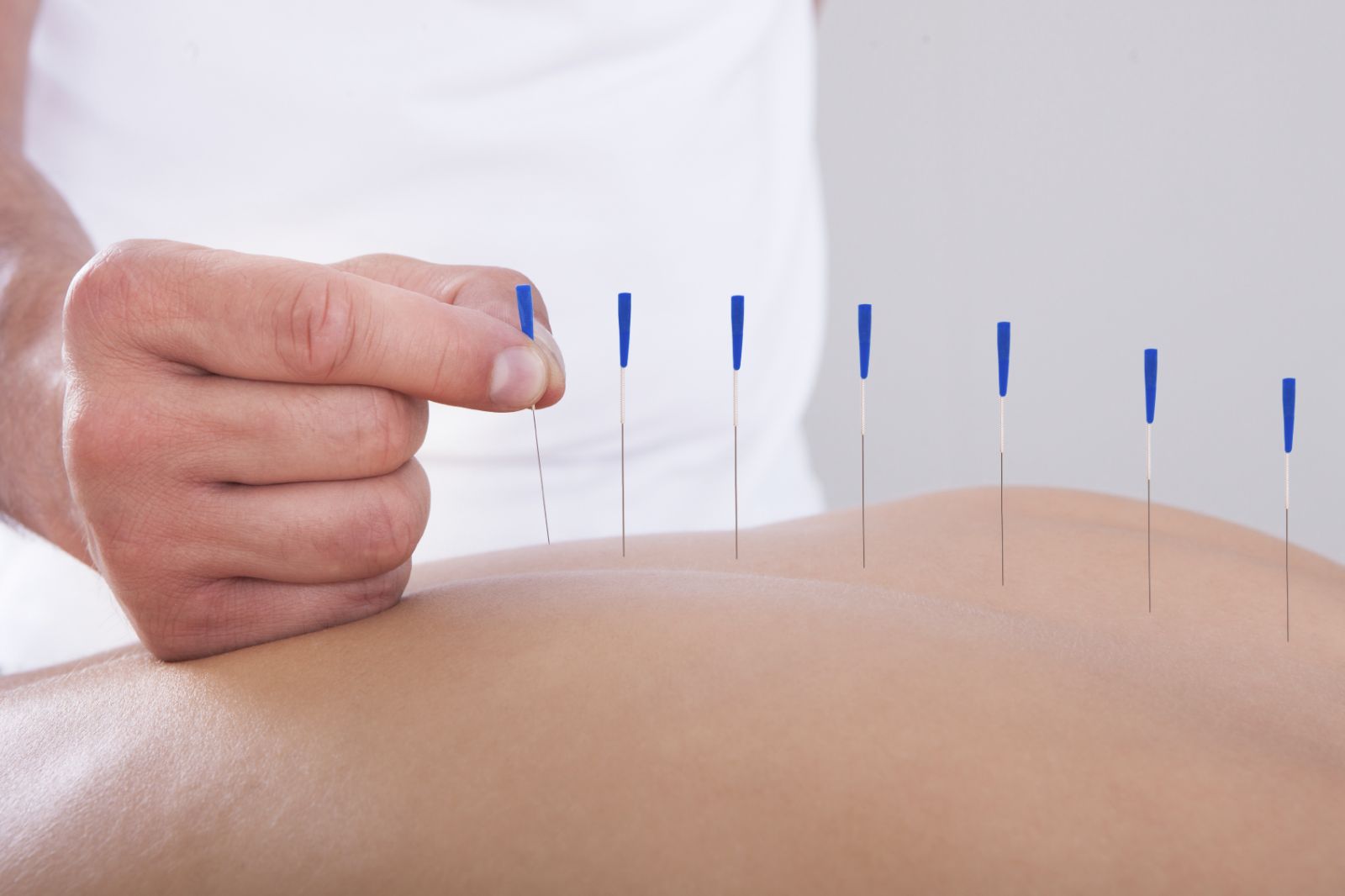 Acupuncture for Infertility