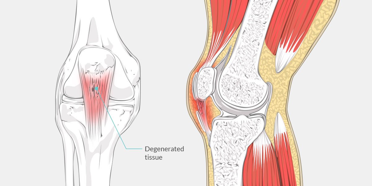 kneecap injury symptoms