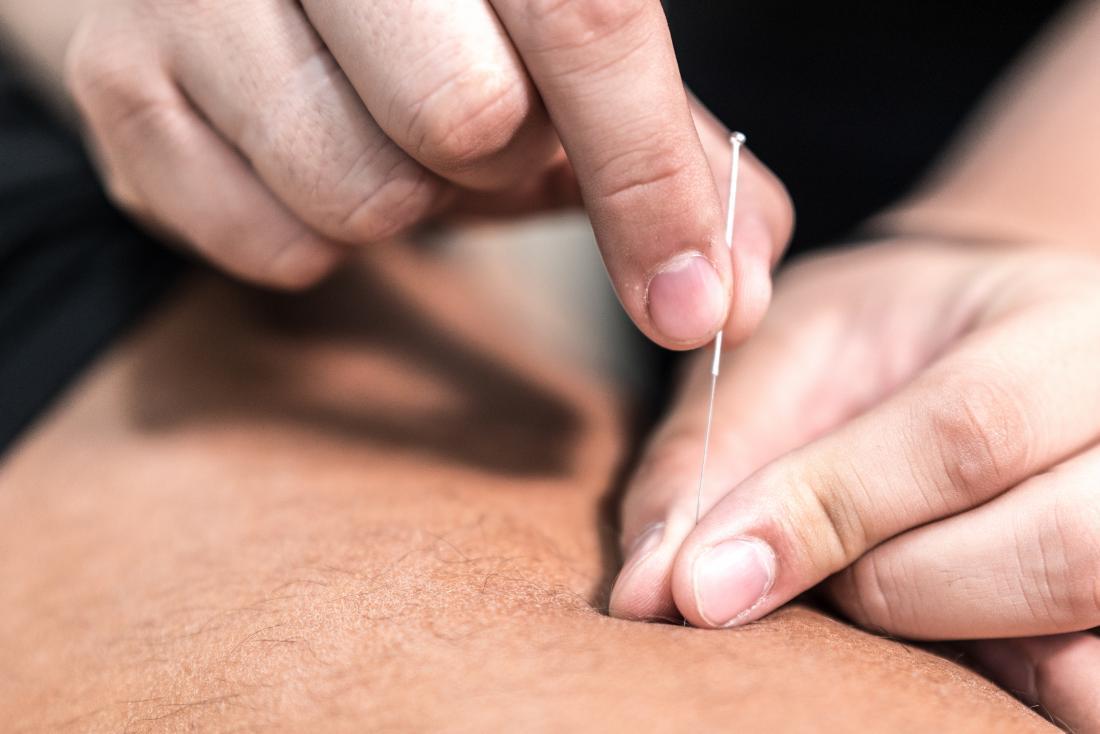 Benefits and Uses for Acupuncture