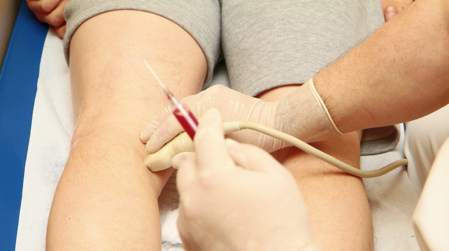 Prolotherapy and PRP tennis Elbow Injections