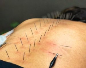 acupuncture chiropractic