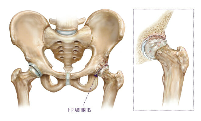 Treatment of Hip Osteoarthritis With PRP Injections