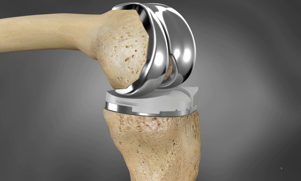 3D Printed Implant Used to Repair Knee Cartilage