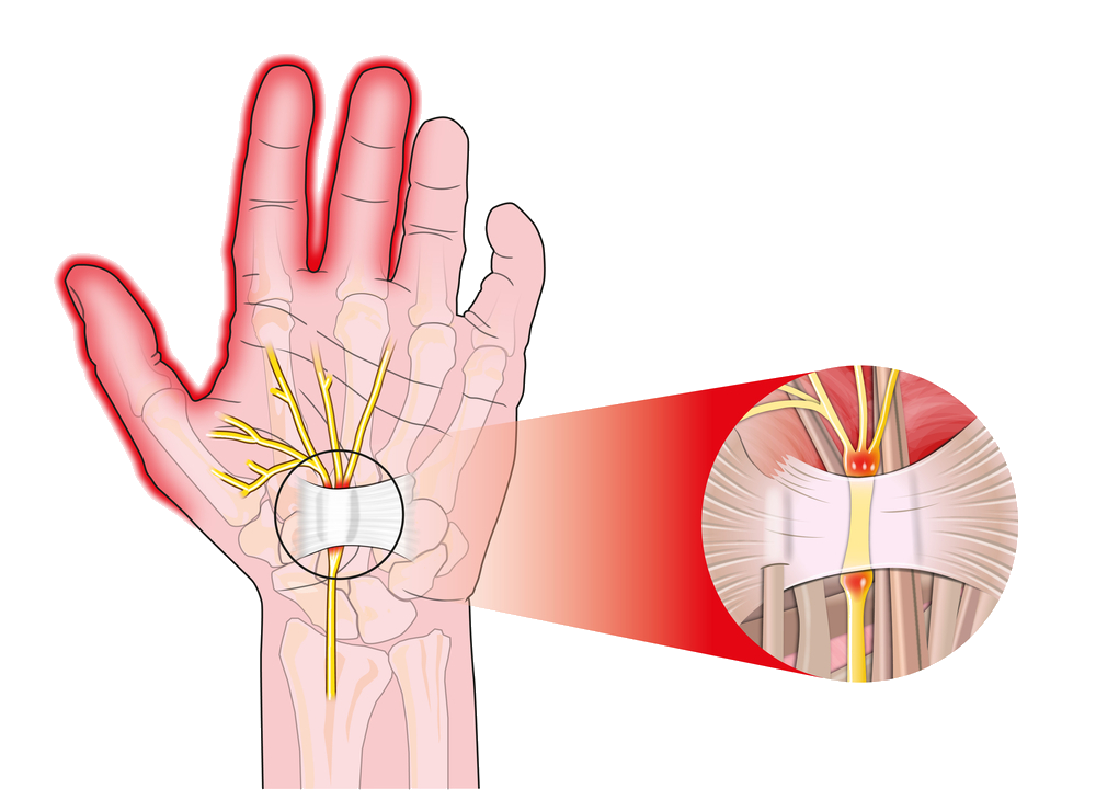 How Do I Get Instant Relief From Carpal Tunnel?