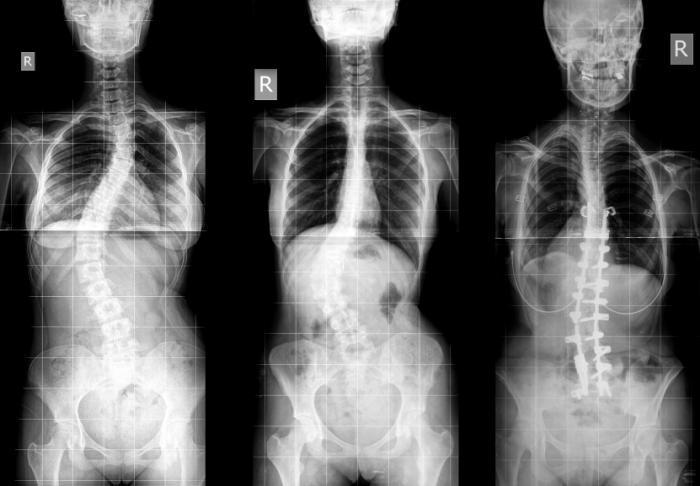 What is the Best Treatment for Scoliosis?