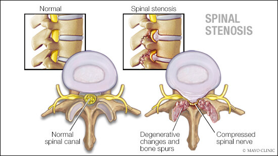 Can A Chiropractor Help With Spinal Stenosis?