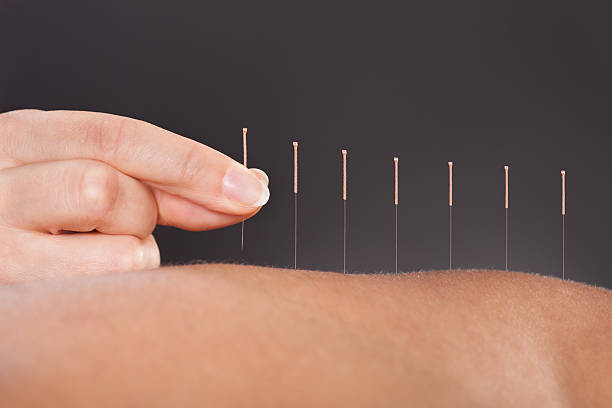 Acupuncture for Stress and Weight Gain?