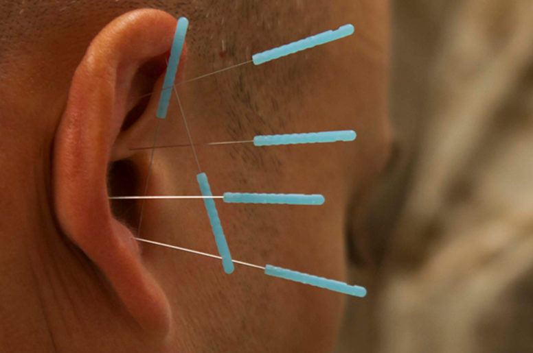 Why Acupuncture Is the Best Tool to Help with Detoxification