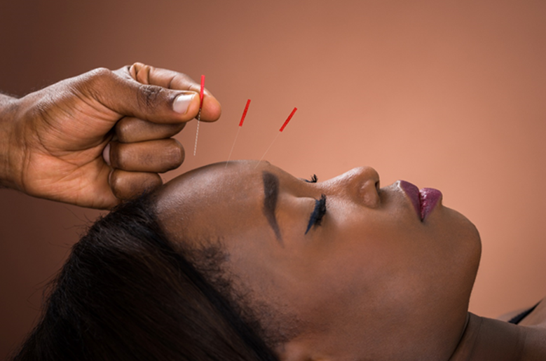 How Can Acupuncture Help Me Recover After a Car Accident?